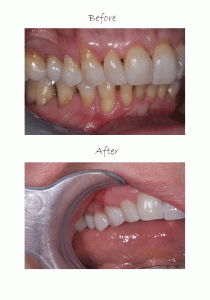 PST-before-and-after