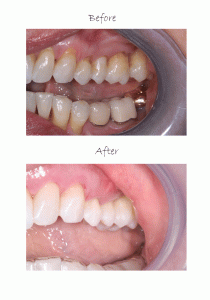 pinhole-surgical-technique-before-and-after