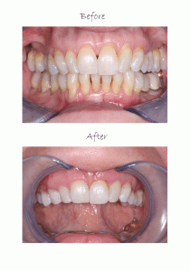 pinhole-surgical-technique-before-and-after