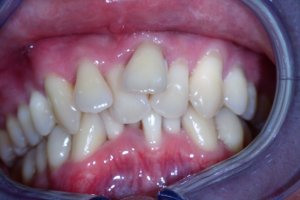 crowded-teeth