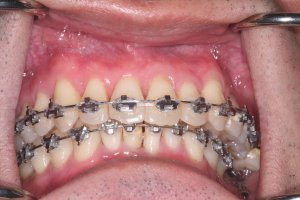 braces-after-arch-development