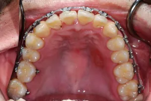 upper-dental-arch-braces